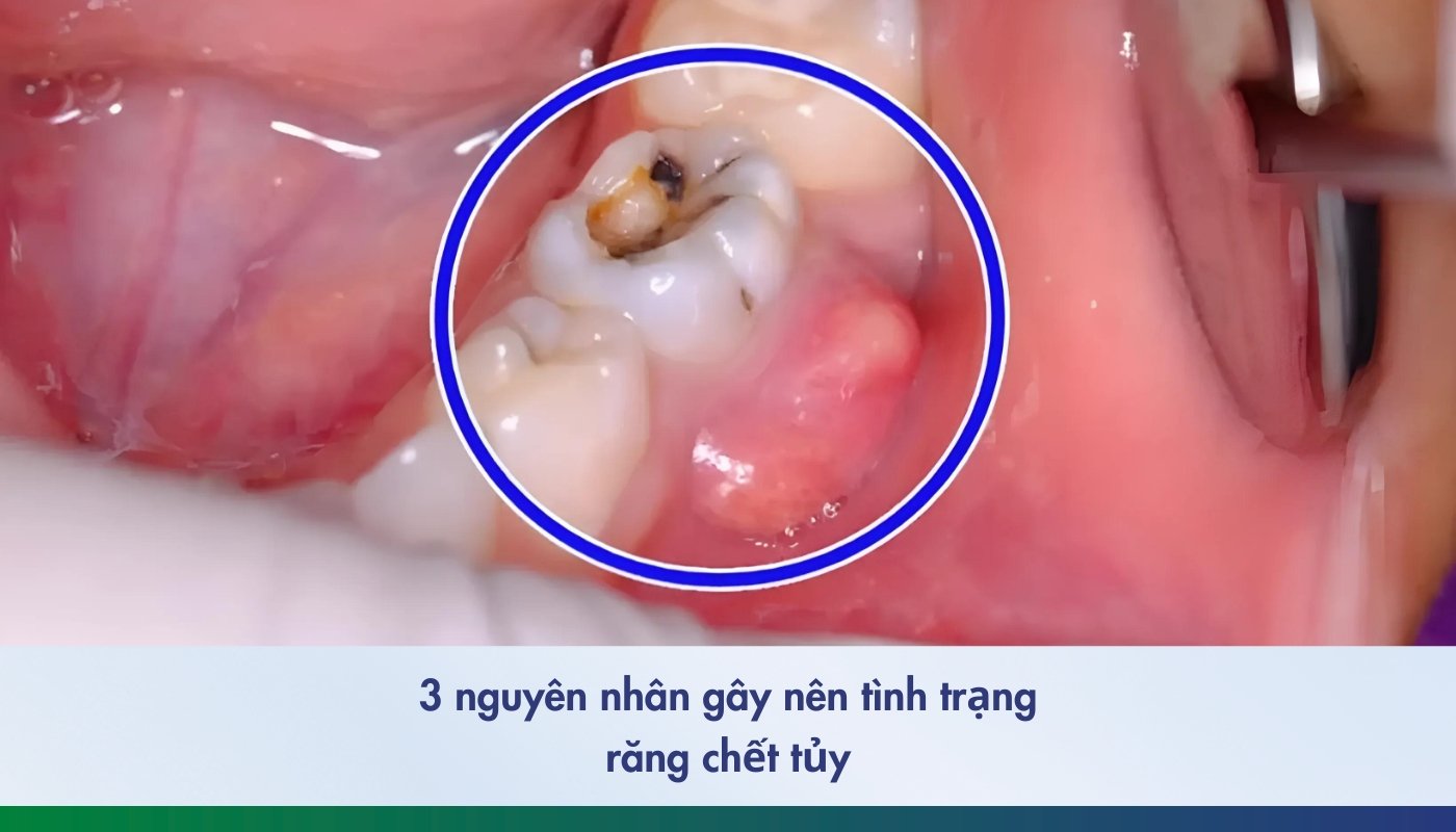 3 nguyên nhân gây nên tình trạng răng chết tủy