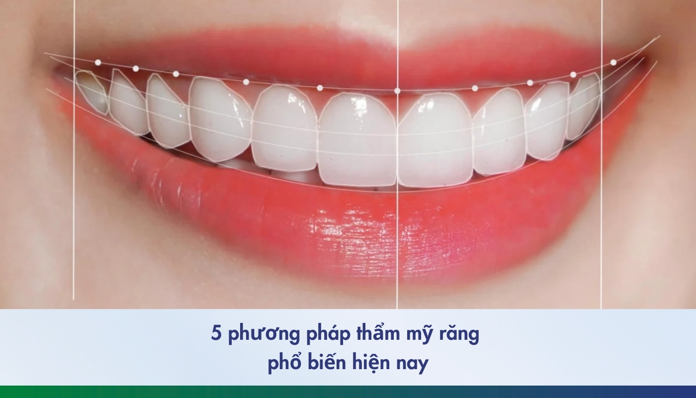 5 phương pháp thẩm mỹ răng phổ biến