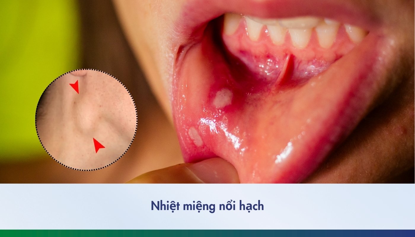 Nhiệt miệng nổi hạch