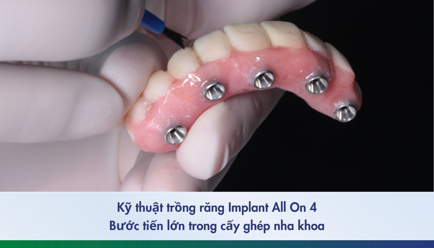 Kỹ thuật trồng răng Implant All On 4 toàn hàm