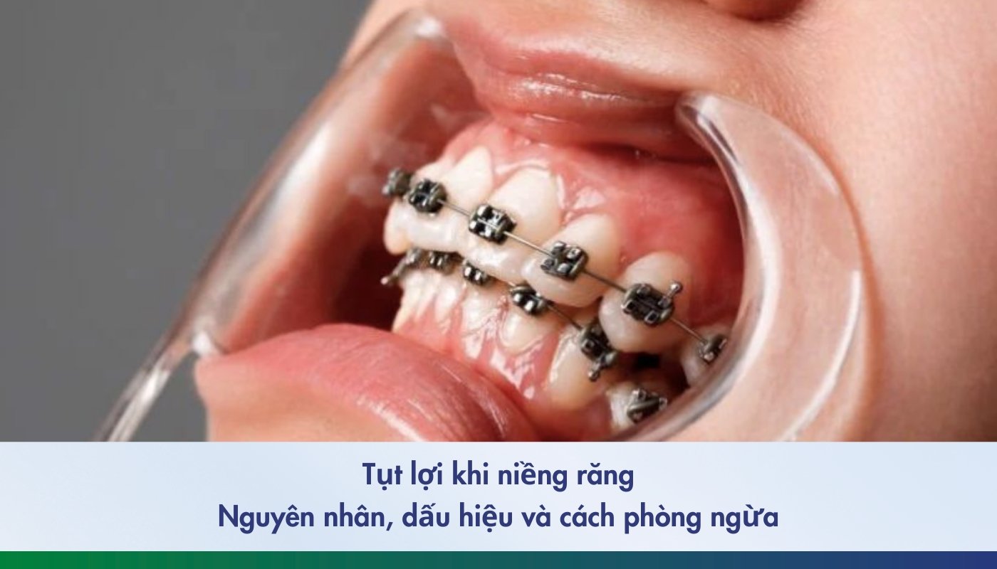 Tụt lợi khi niềng răng: Nguyên nhân, dấu hiệu và cách phòng ngừa