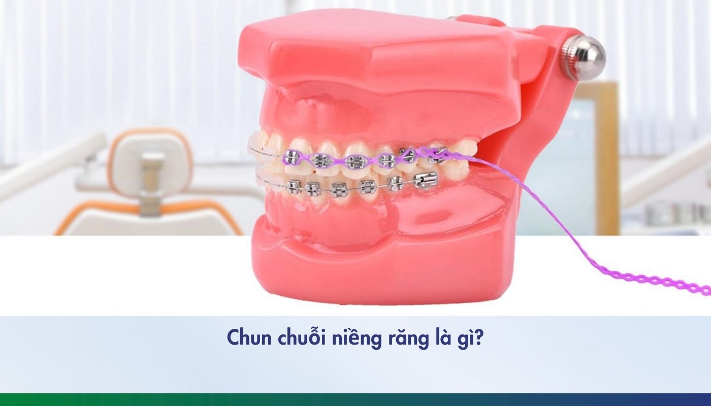 Chun chuỗi niềng răng là gì?