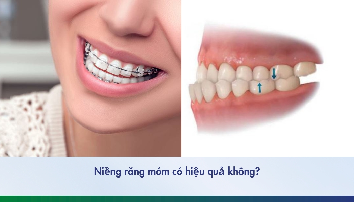 Niềng răng móm có hiệu quả không?