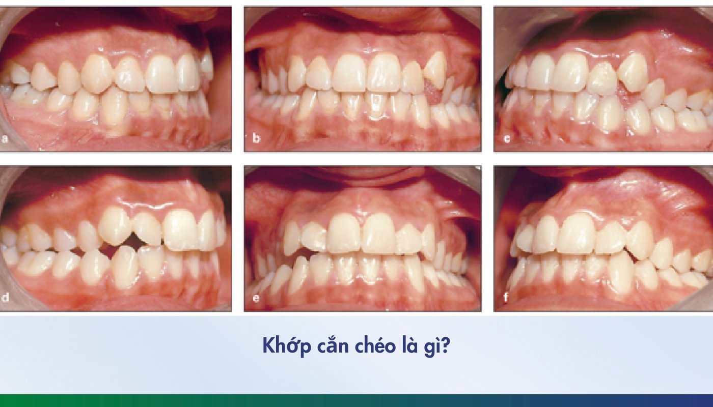 Nguyên nhân và cách khắc phục khớp cắn chéo