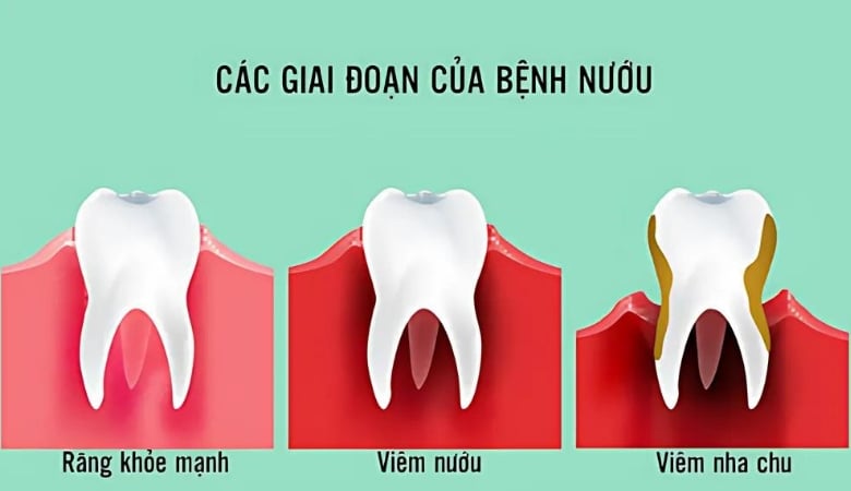 hình ảnh các giai đoạn viêm nha chu dẫn đến thối tủy răng