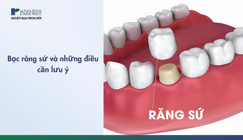 Bọc răng sứ là gì và những điều cần lưu ý