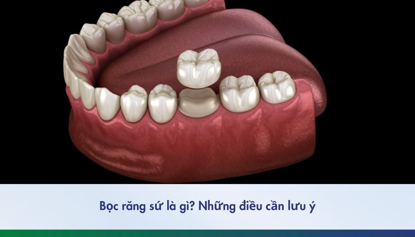 Bọc răng sứ là gì và những điều cần lưu ý - 2