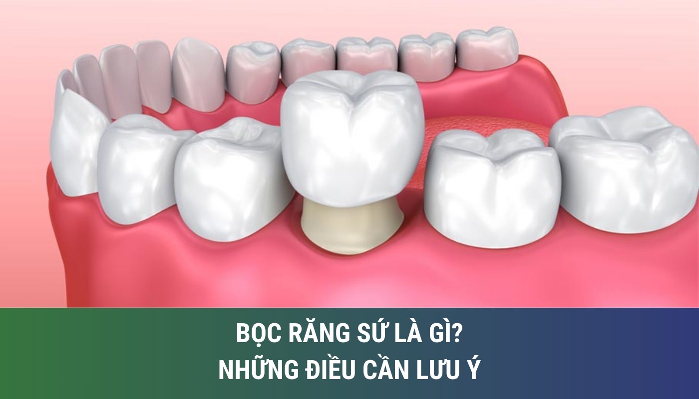 Bọc răng sứ và những điều cần lưu ý