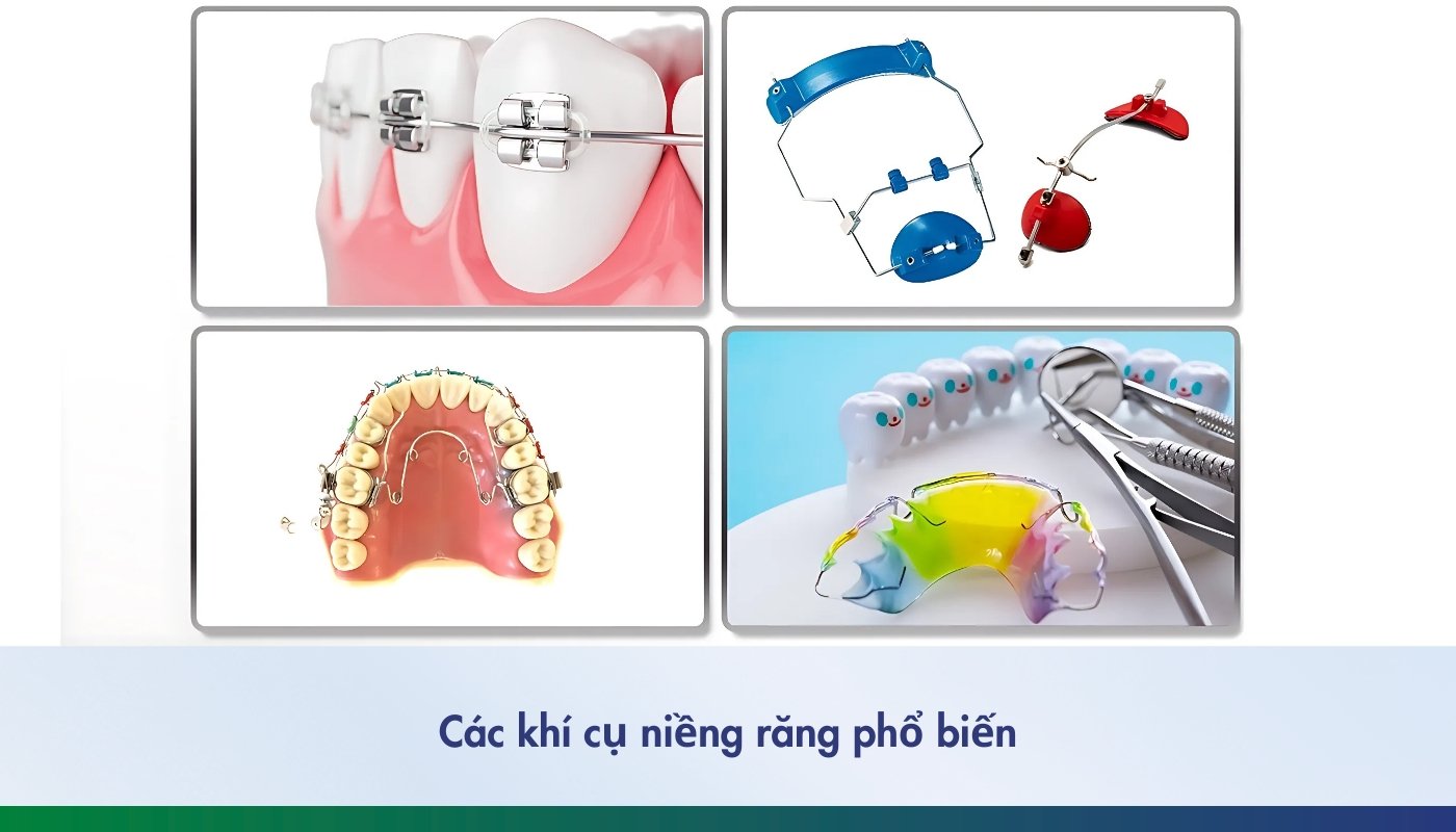 Tổng hợp các khí cụ niềng răng - 2