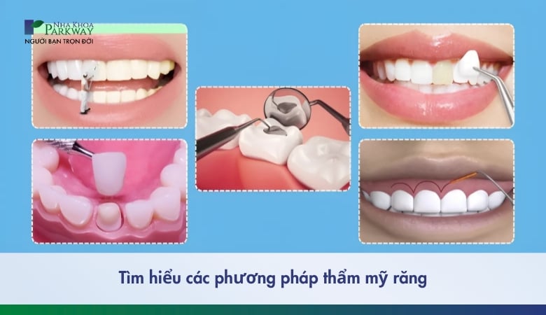 Các phương pháp thẩm mỹ răng 