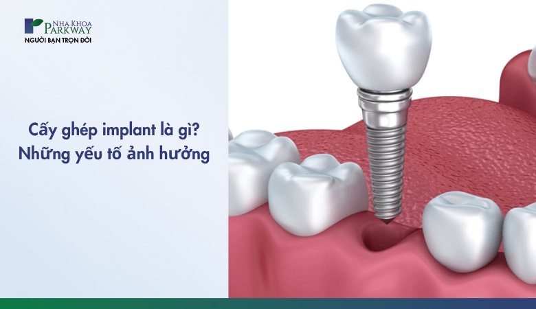 cấy ghép implant là gì - 1