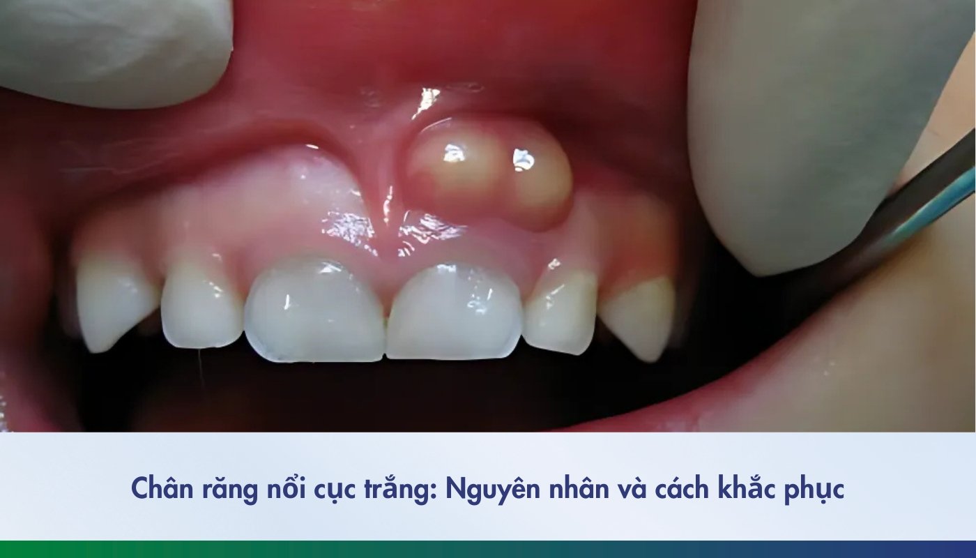 Chân răng nổi cục trắng - 9