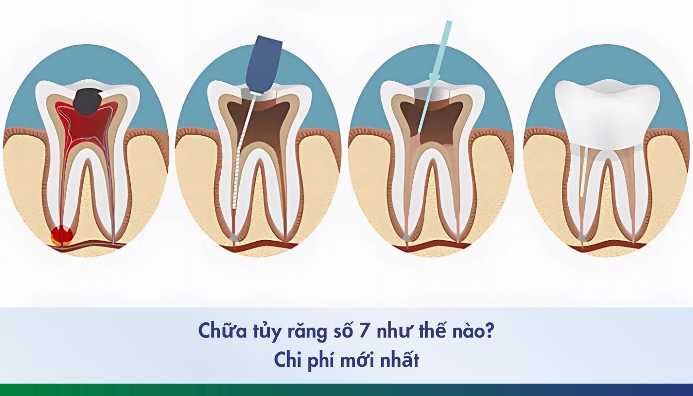 Chữa tủy răng số 7 như thế nào và chi phí bao nhiêu