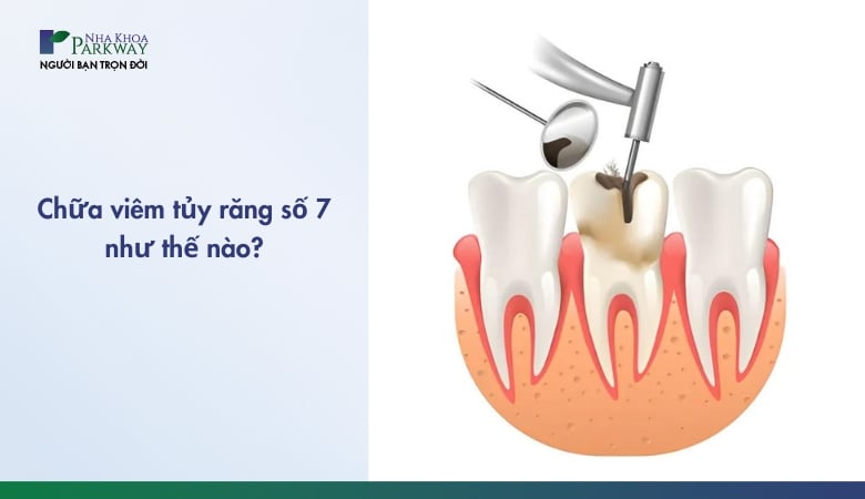 chữa viêm tủy răng số 7 như thế nào