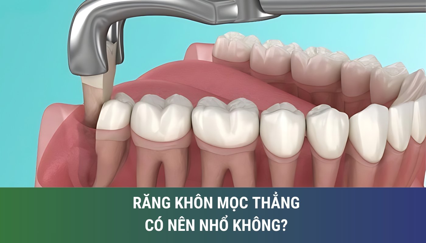 răng khôn mọc thẳng có nên nhổ không?