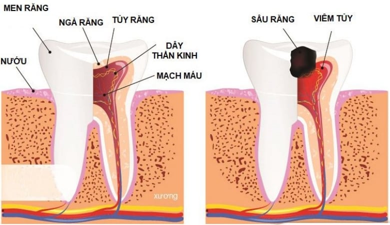 hình ảnh viêm tủy răng nhẹ có thể phục hồi được