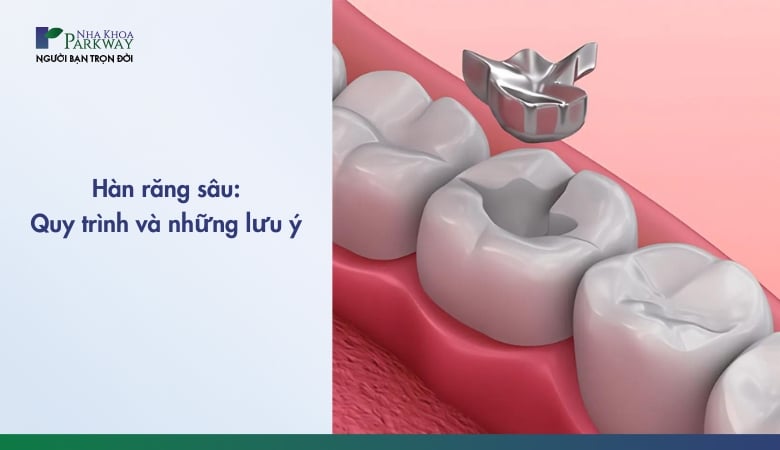 hàn răng sâu và những lưu ý