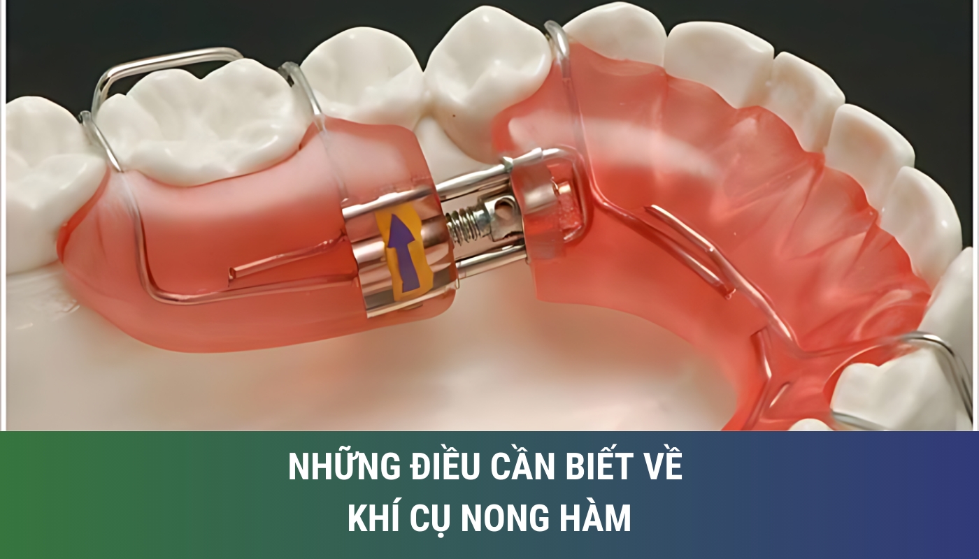 Những điều cần biết về khí cụ nong hàm