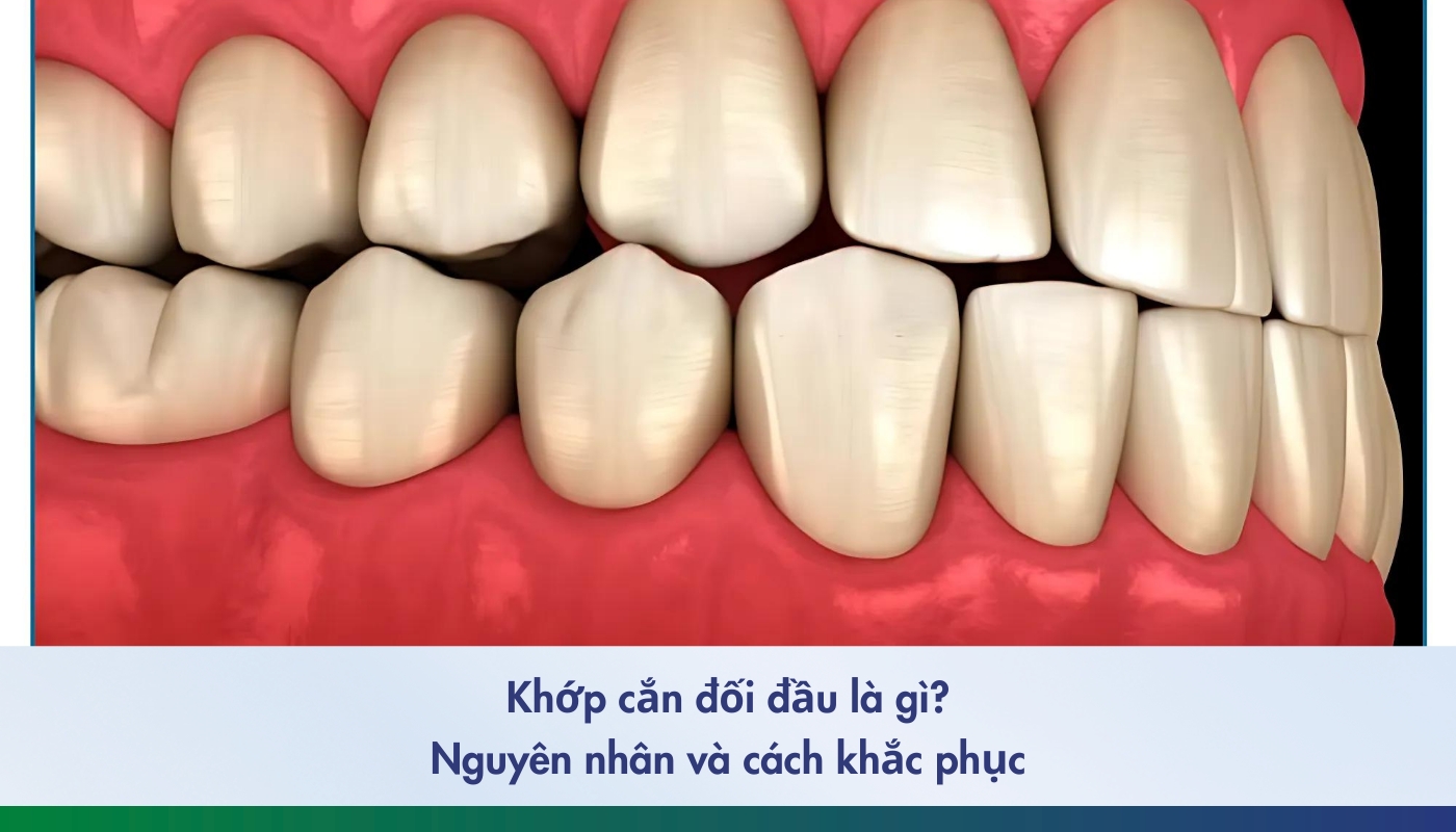 Khớp cắn đối đầu là gì? Nguyên nhân và cách khắc phục