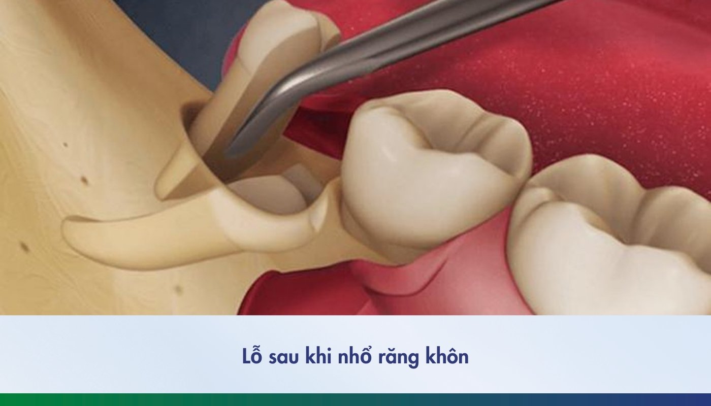 Lỗ sau khi nhổ răng khôn và cách chăm sóc