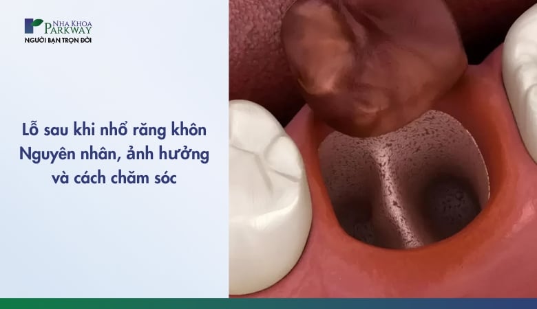 hình ảnh lỗ sau khi nhổ răng khôn