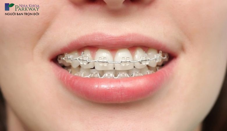 Những ảnh hưởng khi bị răng móm