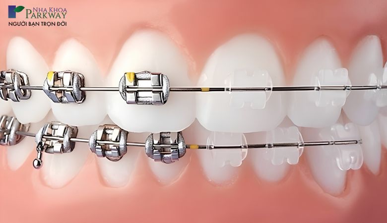 Niềng răng mắc cài sứ