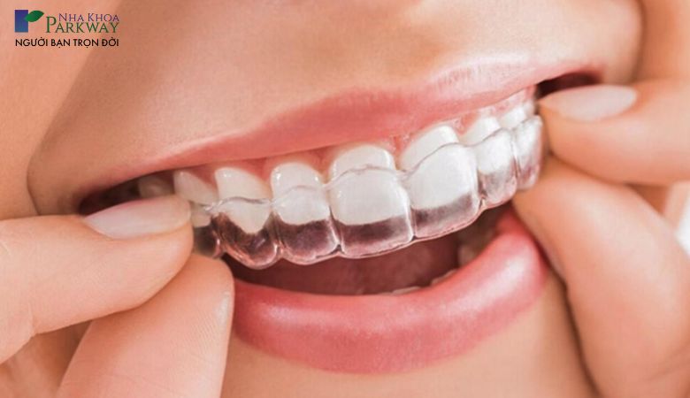 Niềng răng trong suốt Invisalign