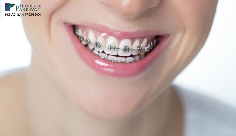 Niềng răng mắc cài tự buộc