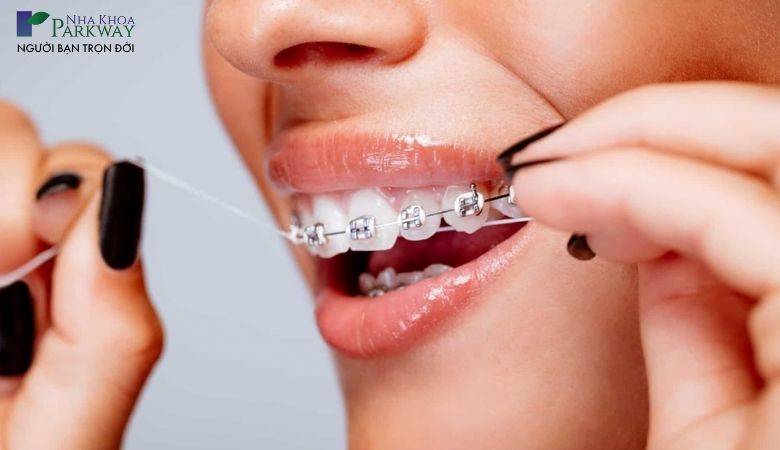 Những điều quan trọng cần lưu ý khi niềng răng móm