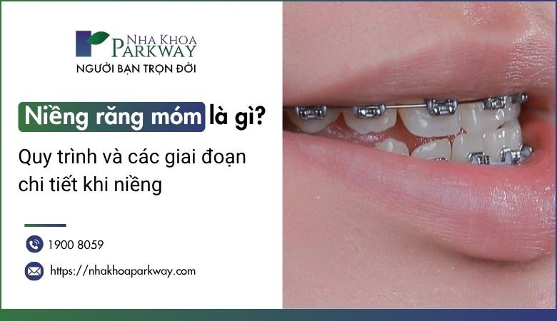 Niềng răng móm là gì? Quy trình và các giai đoạn chi tiết khi niềng