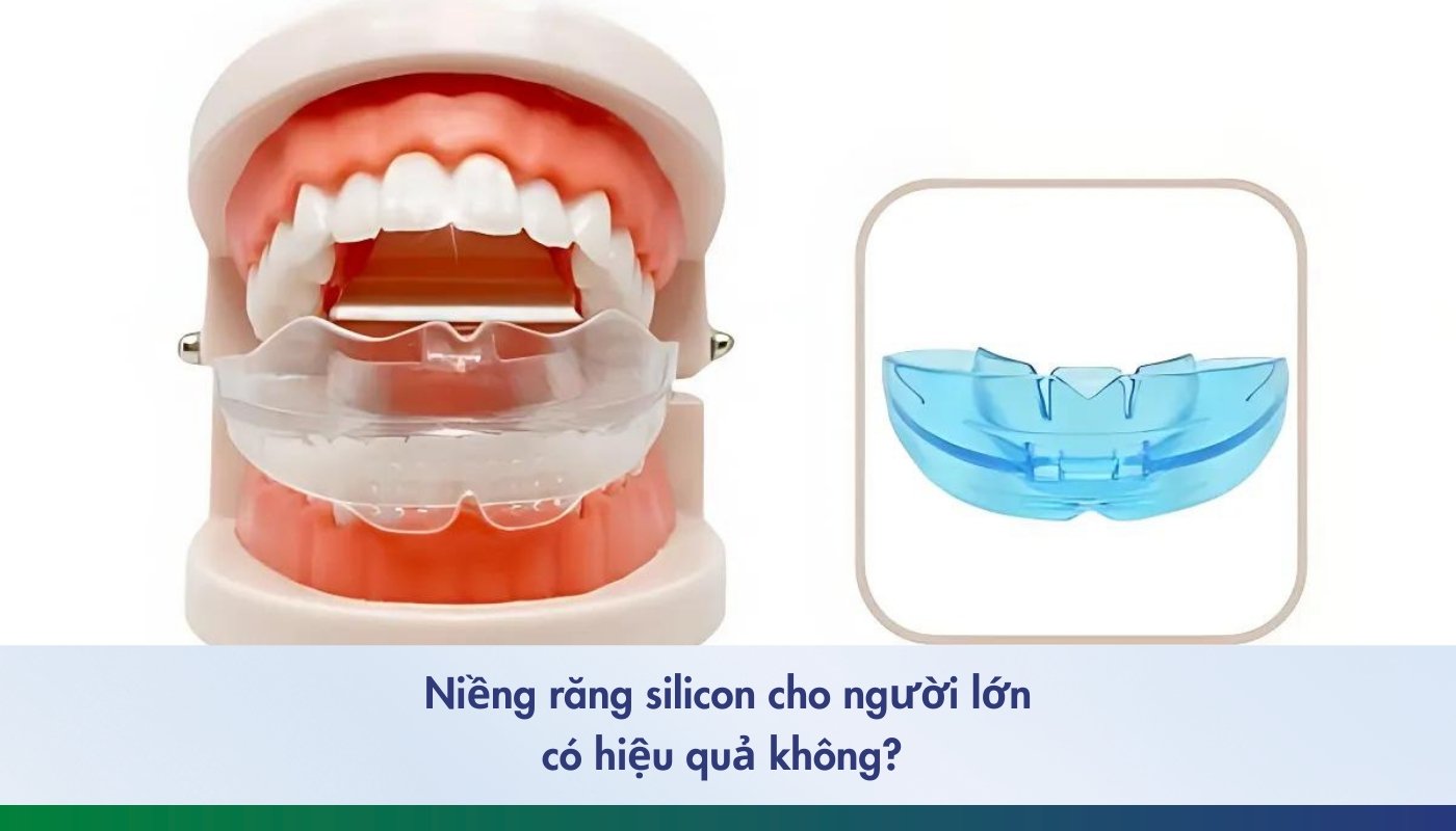 niềng răng silicon cho người lớn - 1