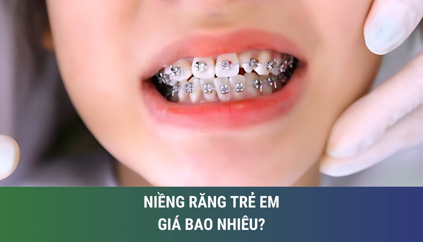 Niềng răng trẻ em giá bao nhiêu