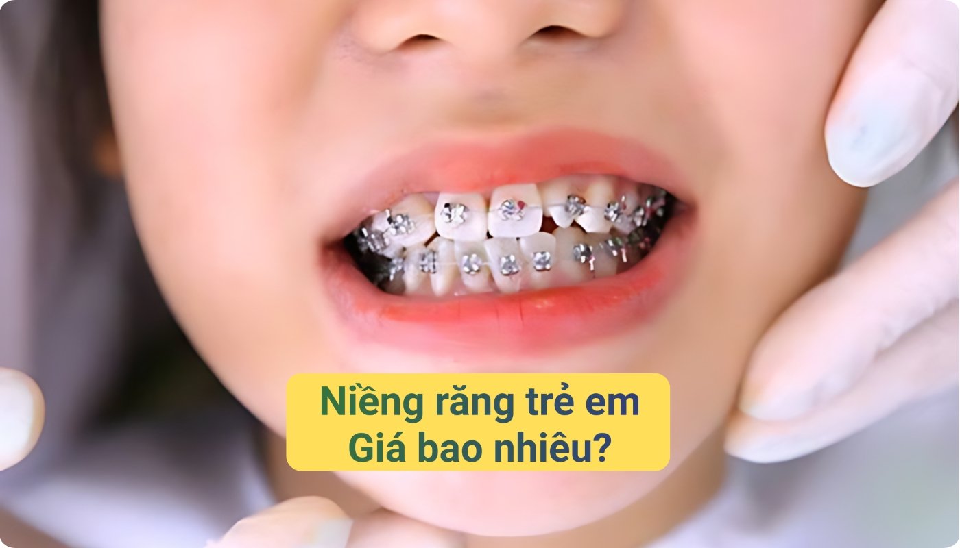 Niềng răng trẻ em giá bao nhiêu