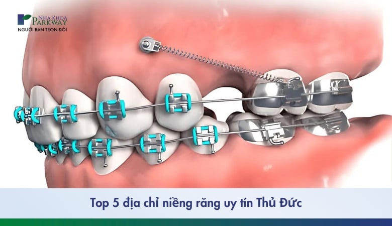 Hình ảnh niềng răng mắc cài