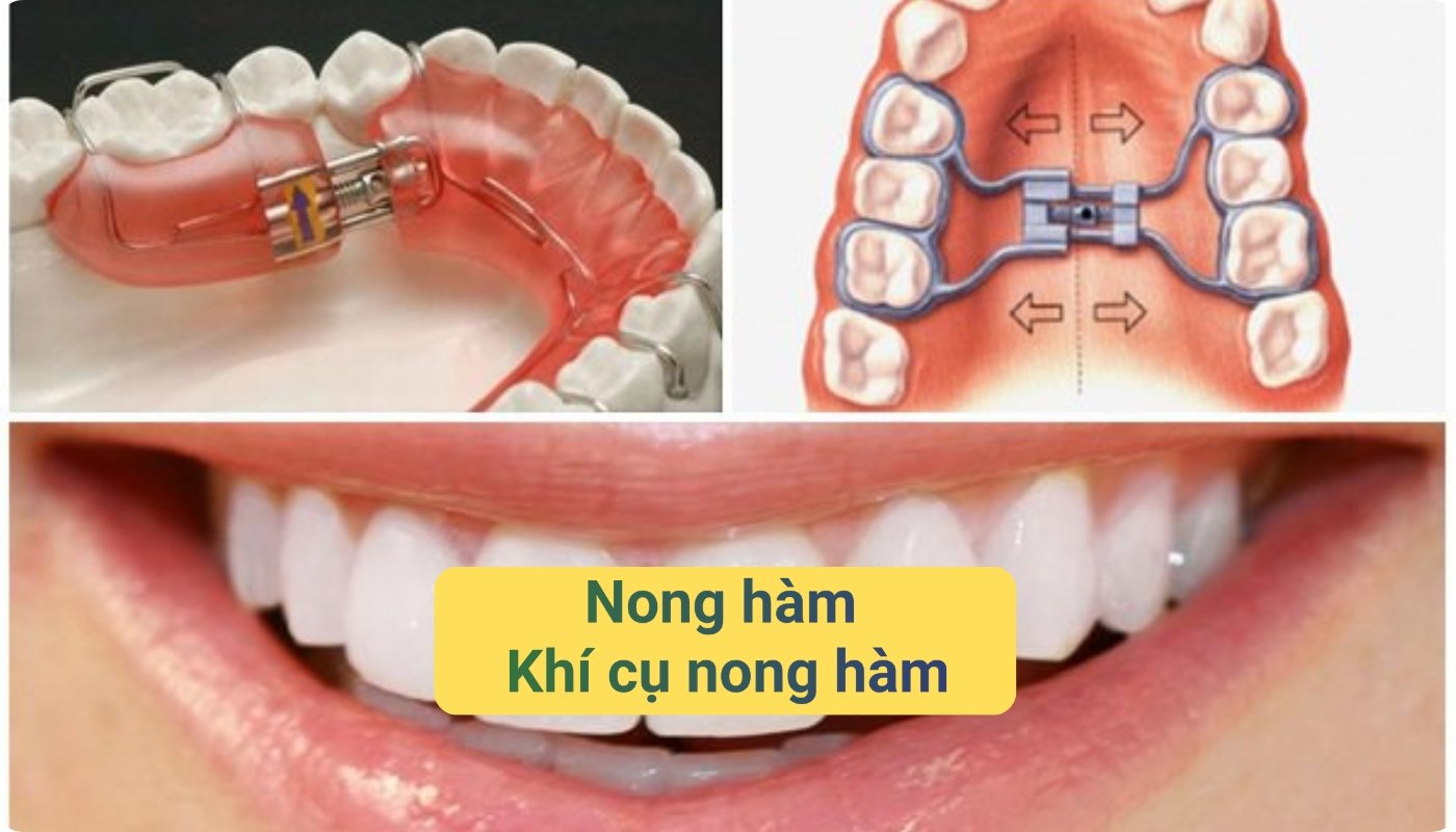 Những điều cần biết về nong hàm và khí cụ nong hàm