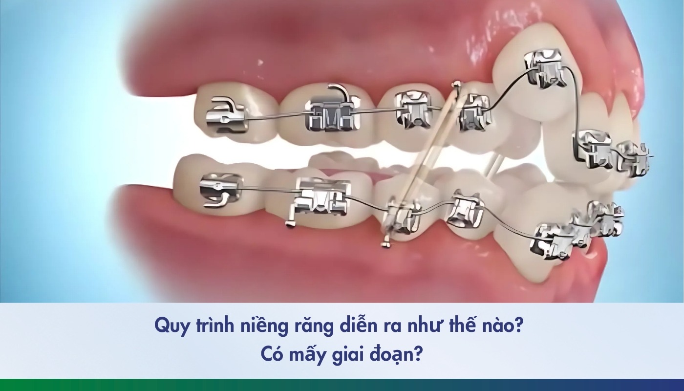 quy trình niềng răng có mấy giai đoạn