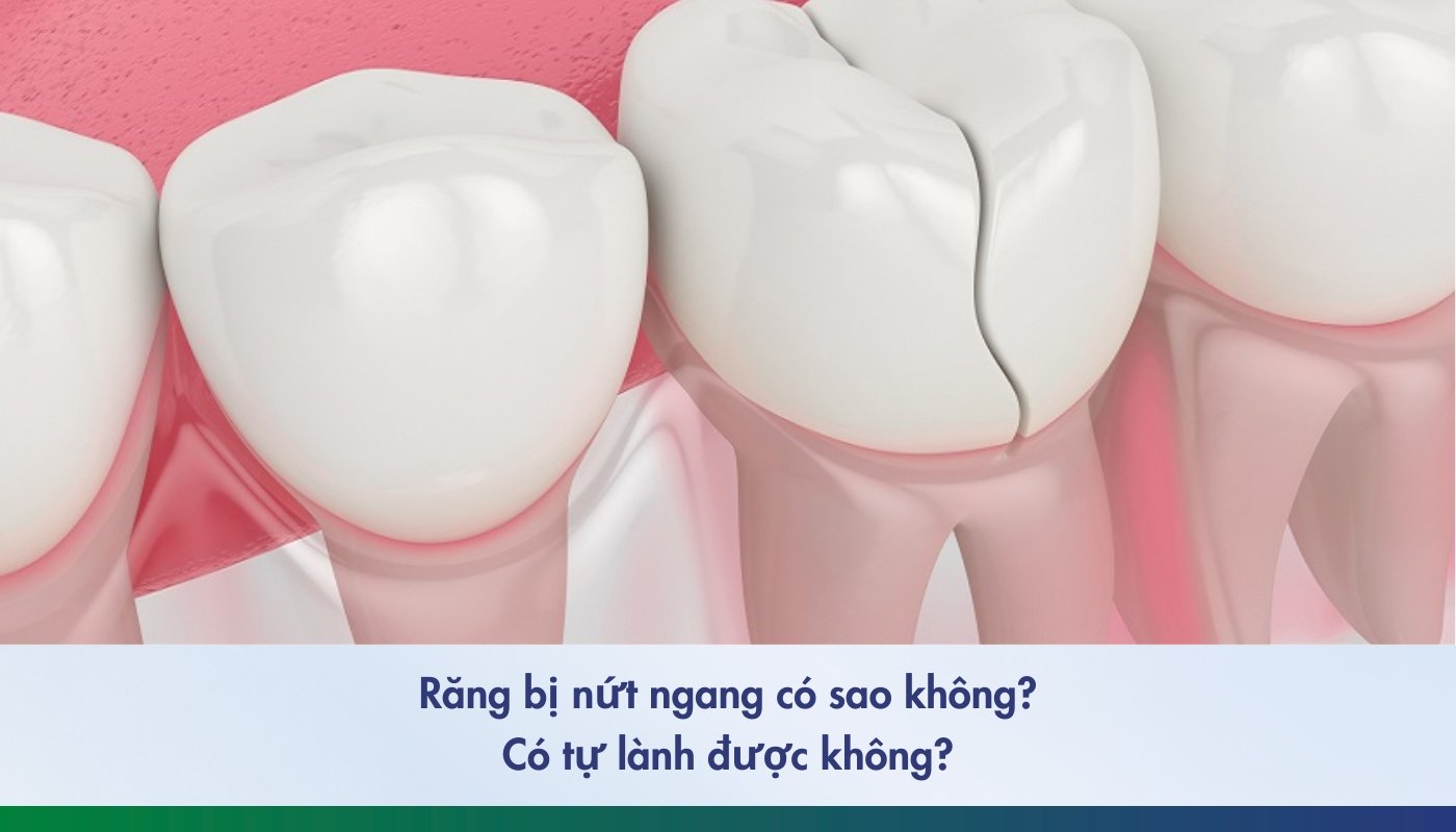 răng bị nứt ngang có sao không - 2