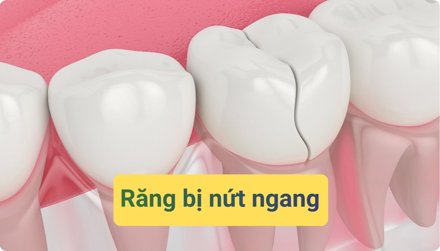 răng bị nứt ngang