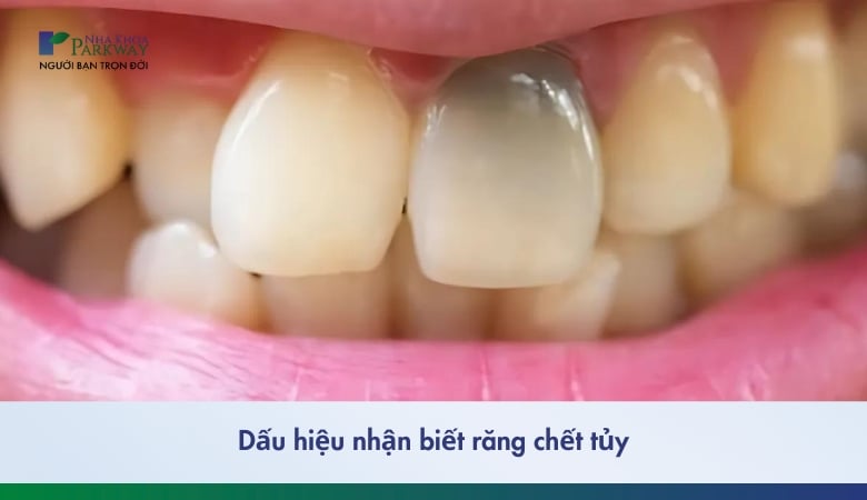 Dấu hiệu nhận biết răng chết tủy - 1