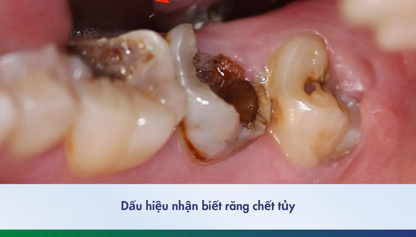 Dấu hiệu nhận biết răng chết tủy - 2