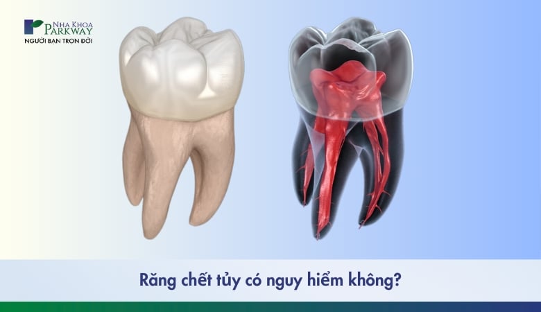 răng chết tủy có nguy hiểm không?