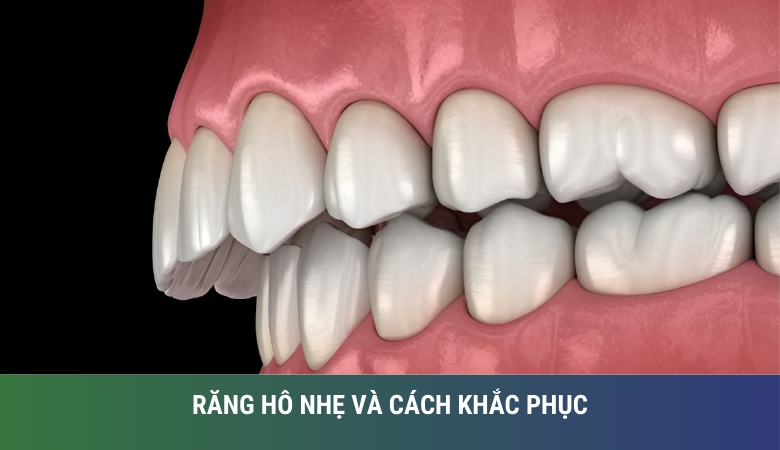 Răng hô nhẹ và cách khắc phục