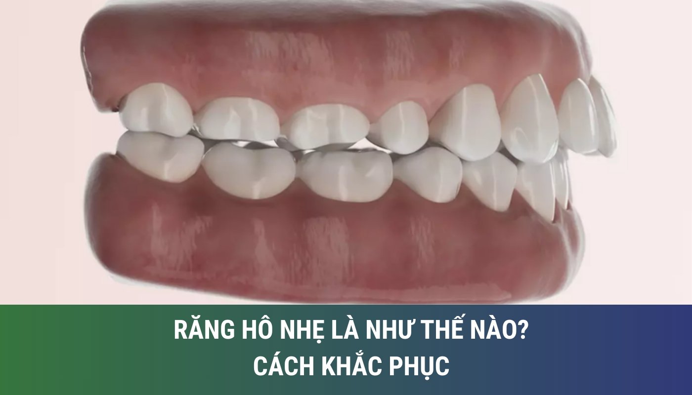 răng hô nhẹ là như thế nào? Cách khắc phục