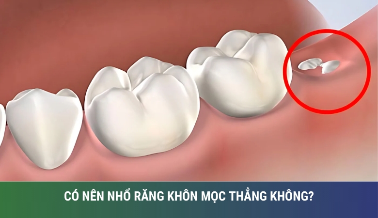 Có nên nhổ răng khôn mọc thẳng không