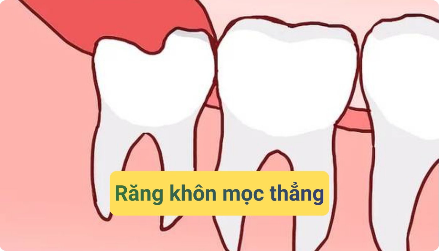 Răng khôn mọc thẳng có nên nhổ không