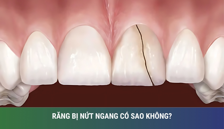 Hình ảnh răng bị nứt ngang