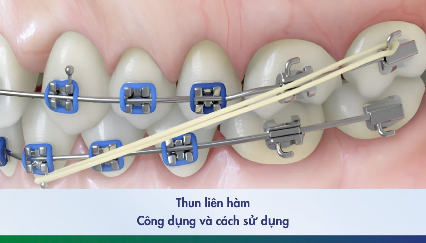 Thun liên hàm và cách sử dụng