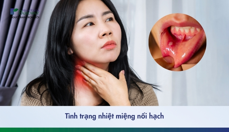 Nhiệt miệng nổi hạch - 1