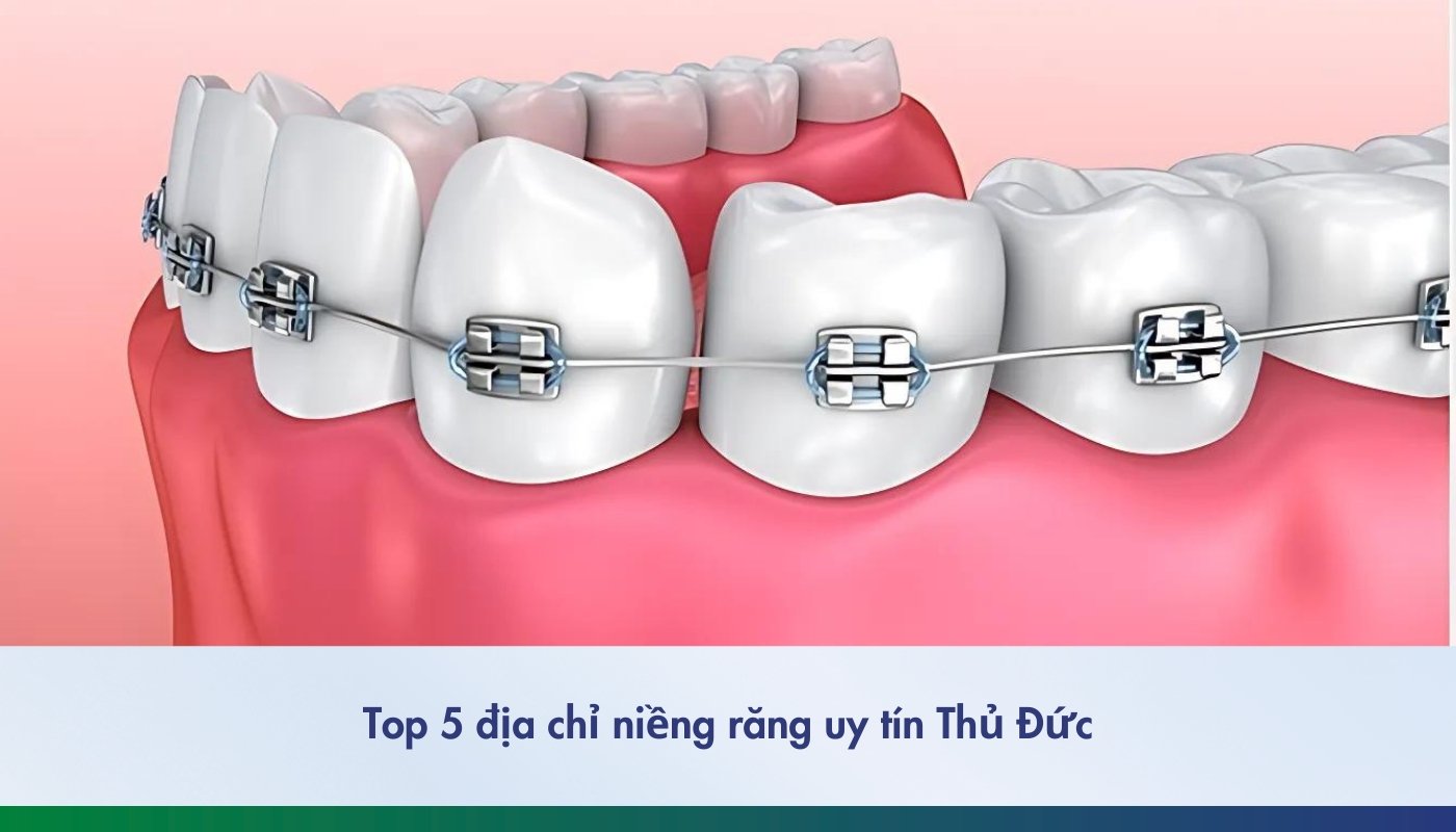 top 5 địa chỉ niềng răng uy tín tại Thủ Đức